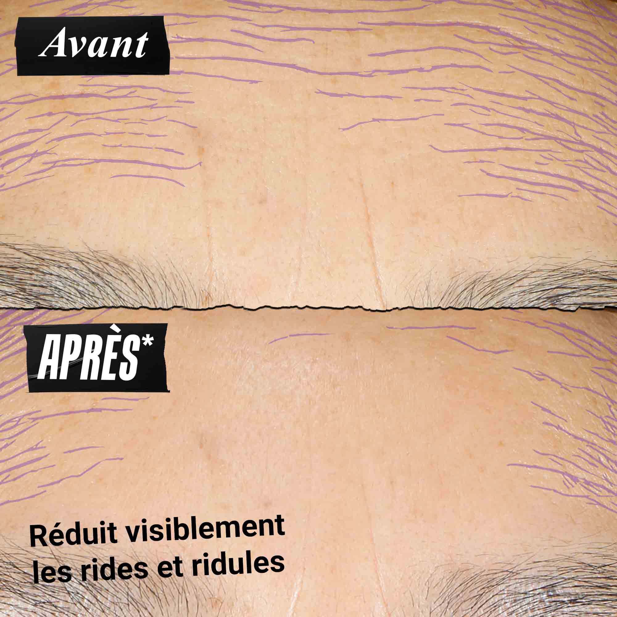 avant apres d'un front avec des ridules
