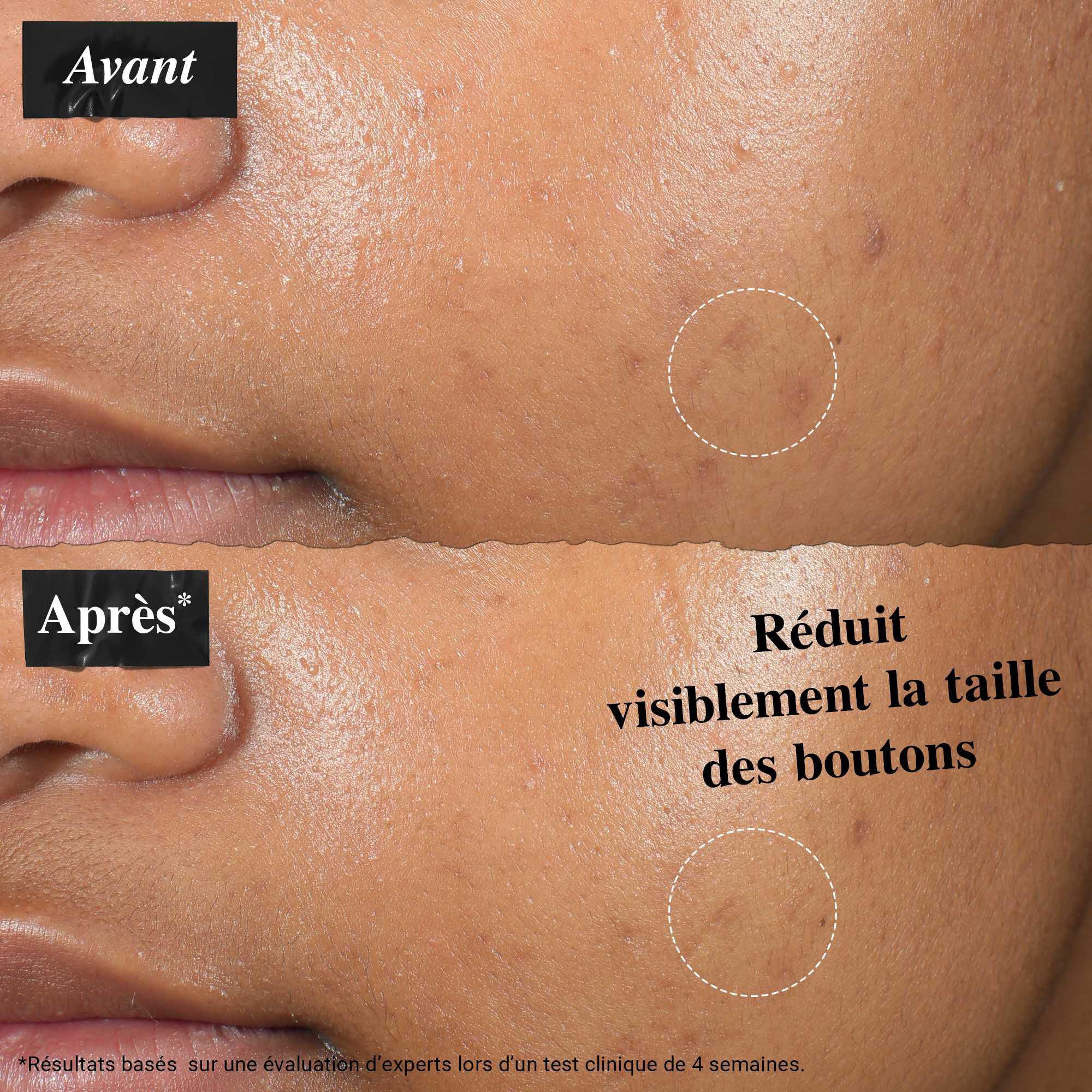 Une comparaison avant/apres montrant la peau traitee avec la solution Truly-Targeted Blemish-Clearing Solution. L'image « avant » montre des boutons visibles, tandis que l'image « apres » montre une taille de bouton reduite.
