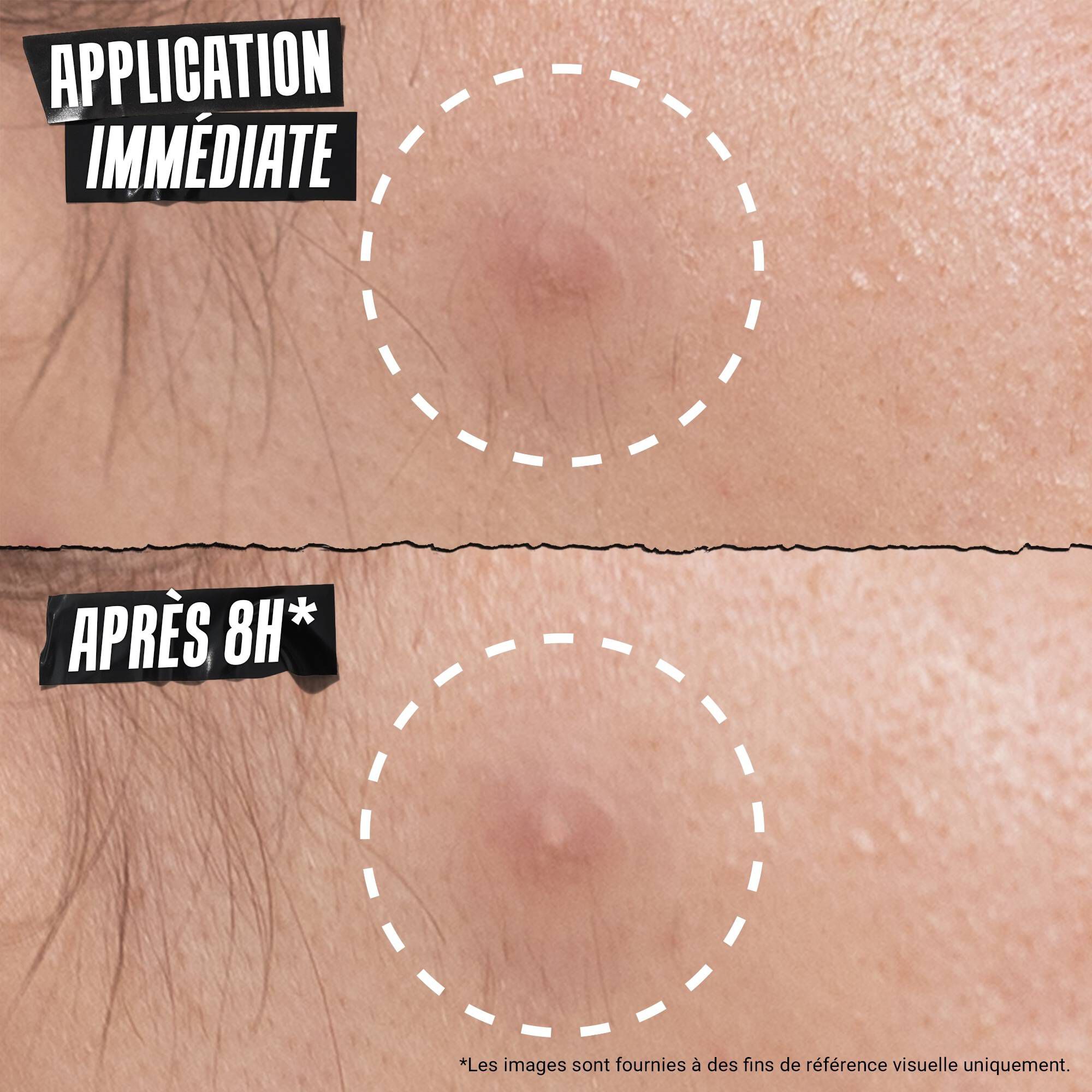 Before and after comparison of a blemish with "Patch On Instantly" and "Patch On After 8HR," demonstrating the patch's effectiveness over time.