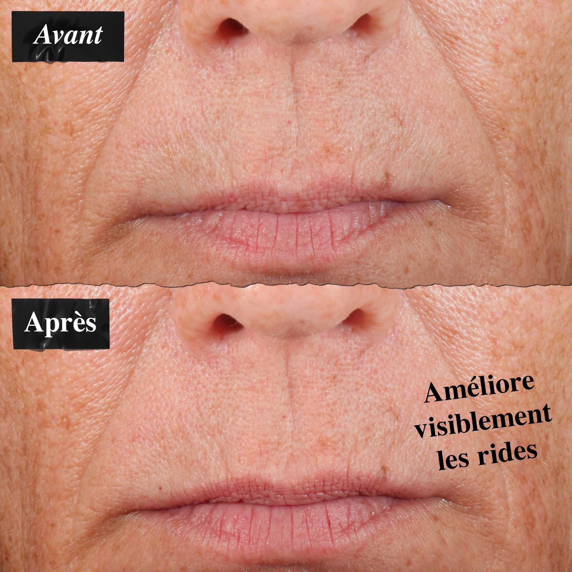 Une comparaison avant/apres montrant une reduction visible des ridules apres utilisation de l'huile pour le visage Midnight Recovery Concentrate.