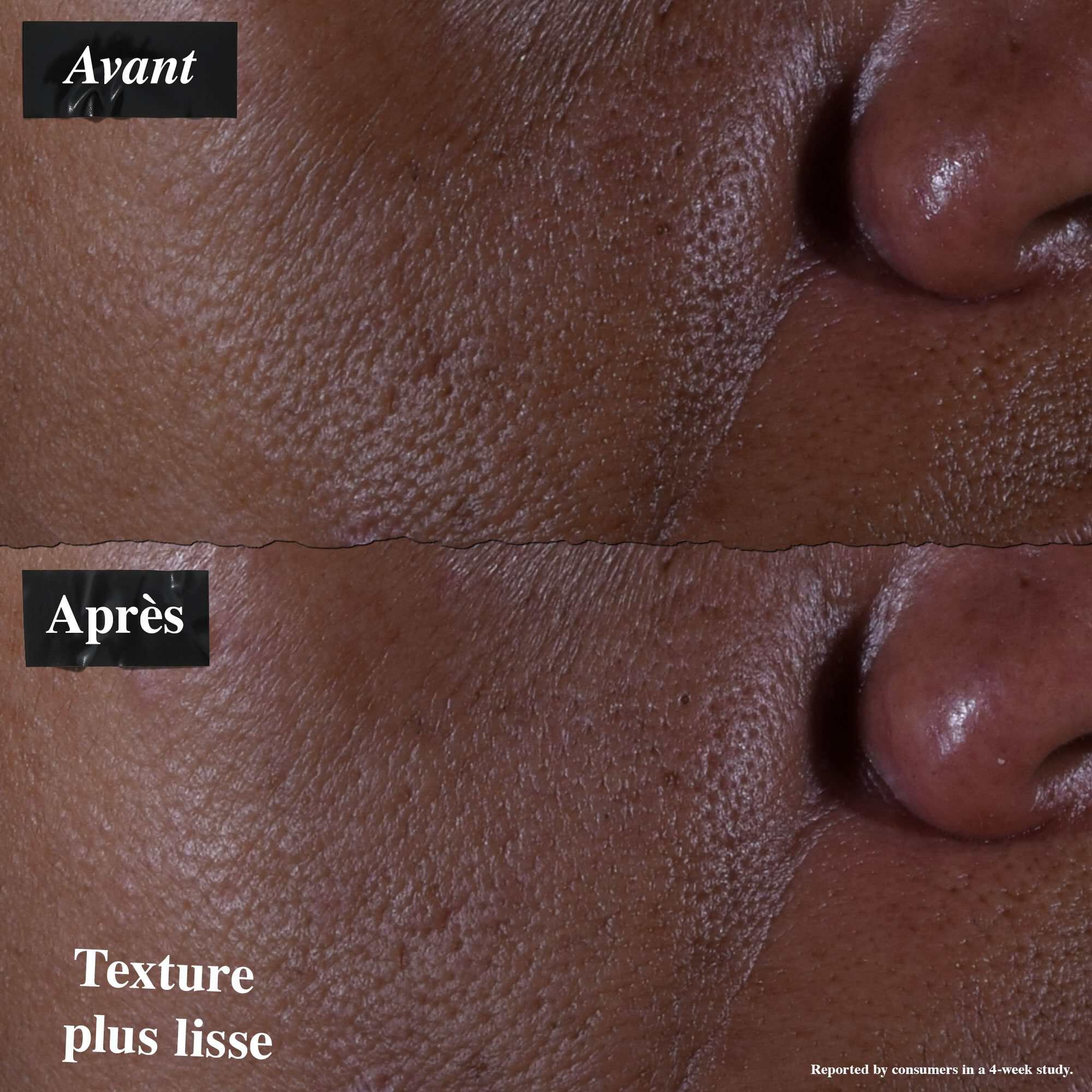Une comparaison avant/apres montrant une peau traitee avec le serum Ultra Pure 9.8% Glycolic Acid. L'image « avant » montre une texture inegale, tandis que l'image « apres » montre une texture plus affinee.