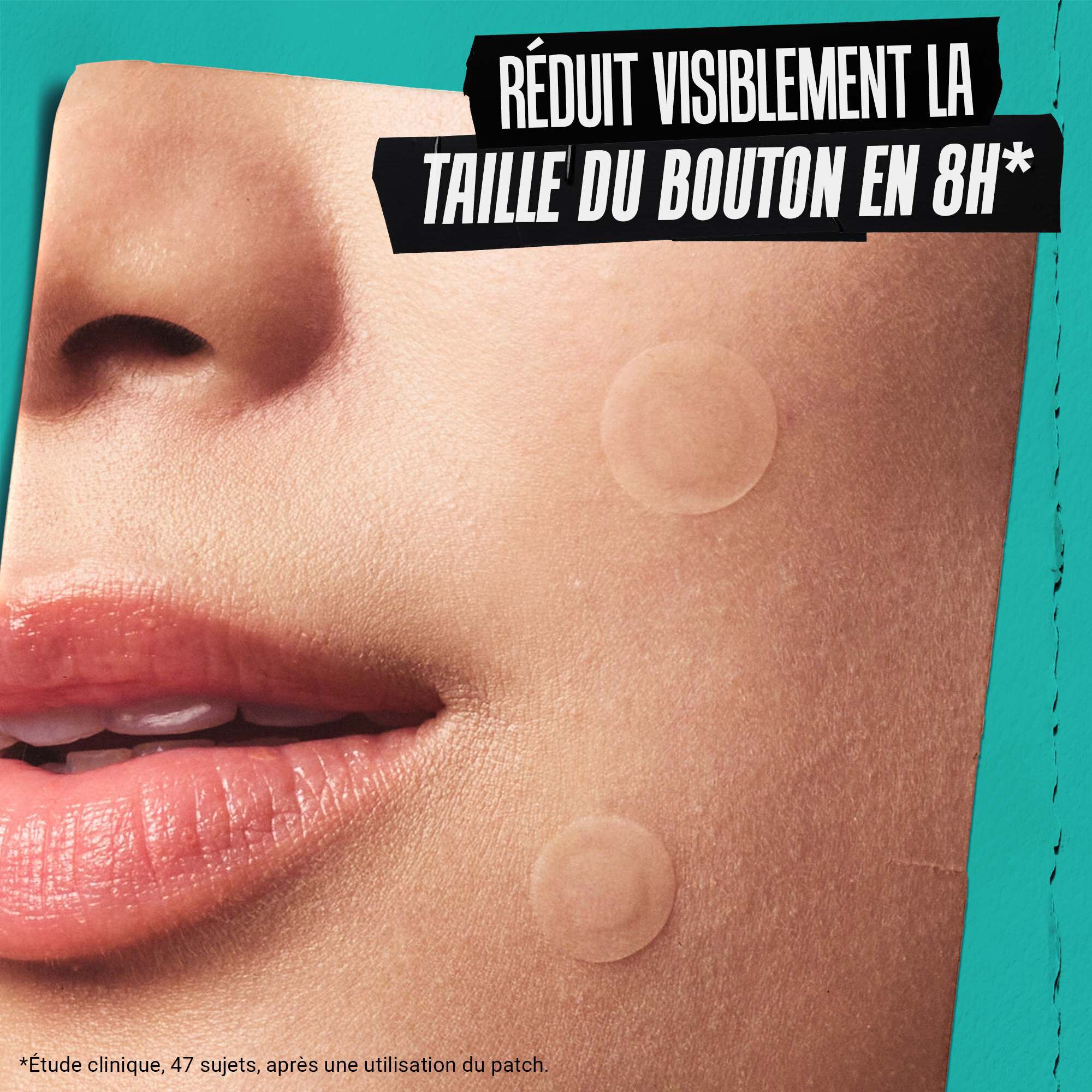 A person's face with blemish patches applied, illustrating how the product "Visibly Flattens Blemishes Overnight."