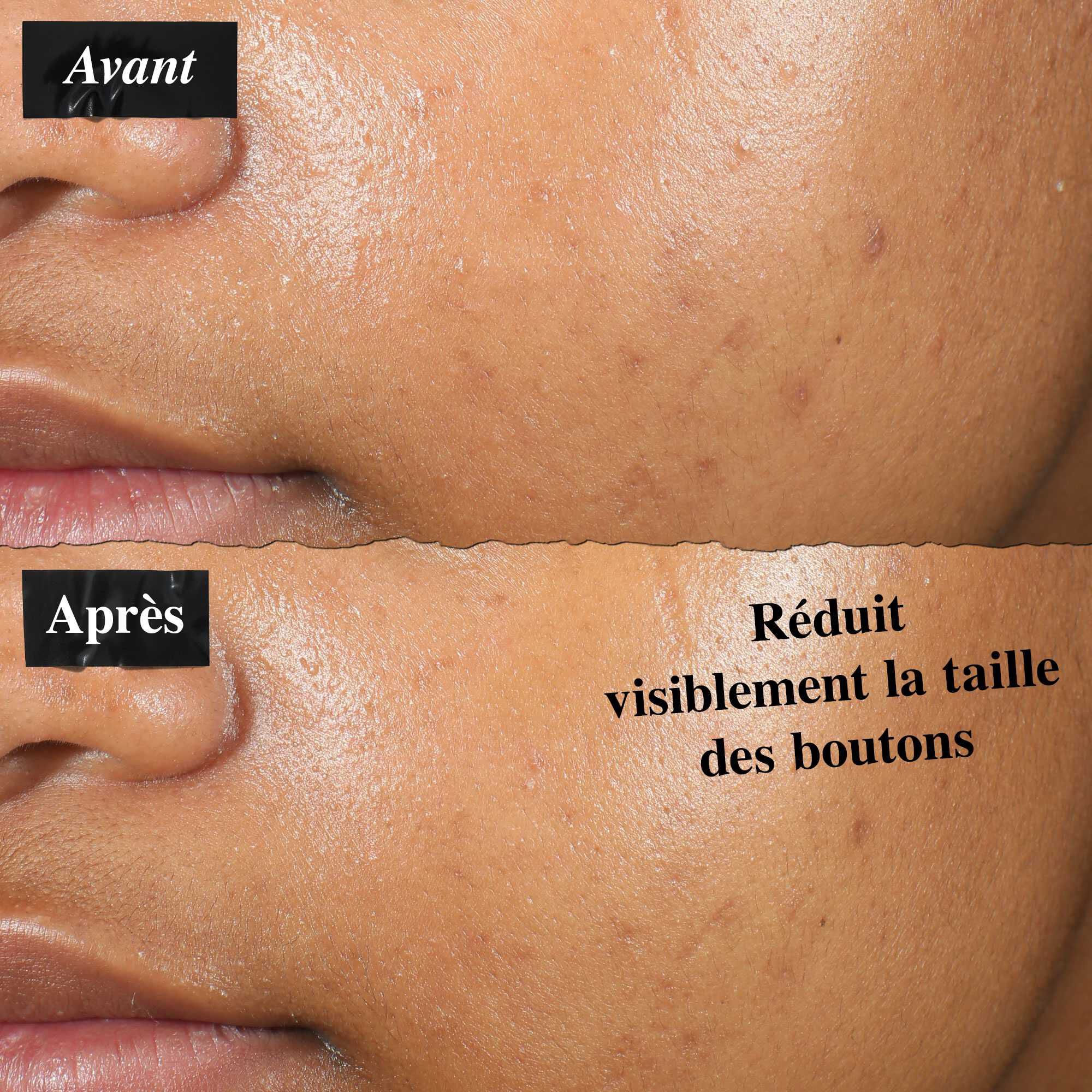 Une comparaison avant/apres montrant la peau traitee avec la solution Truly-Targeted Blemish-Clearing Solution. L'image « avant » montre des boutons visibles, tandis que l'image « apres » montre une taille de bouton reduite.