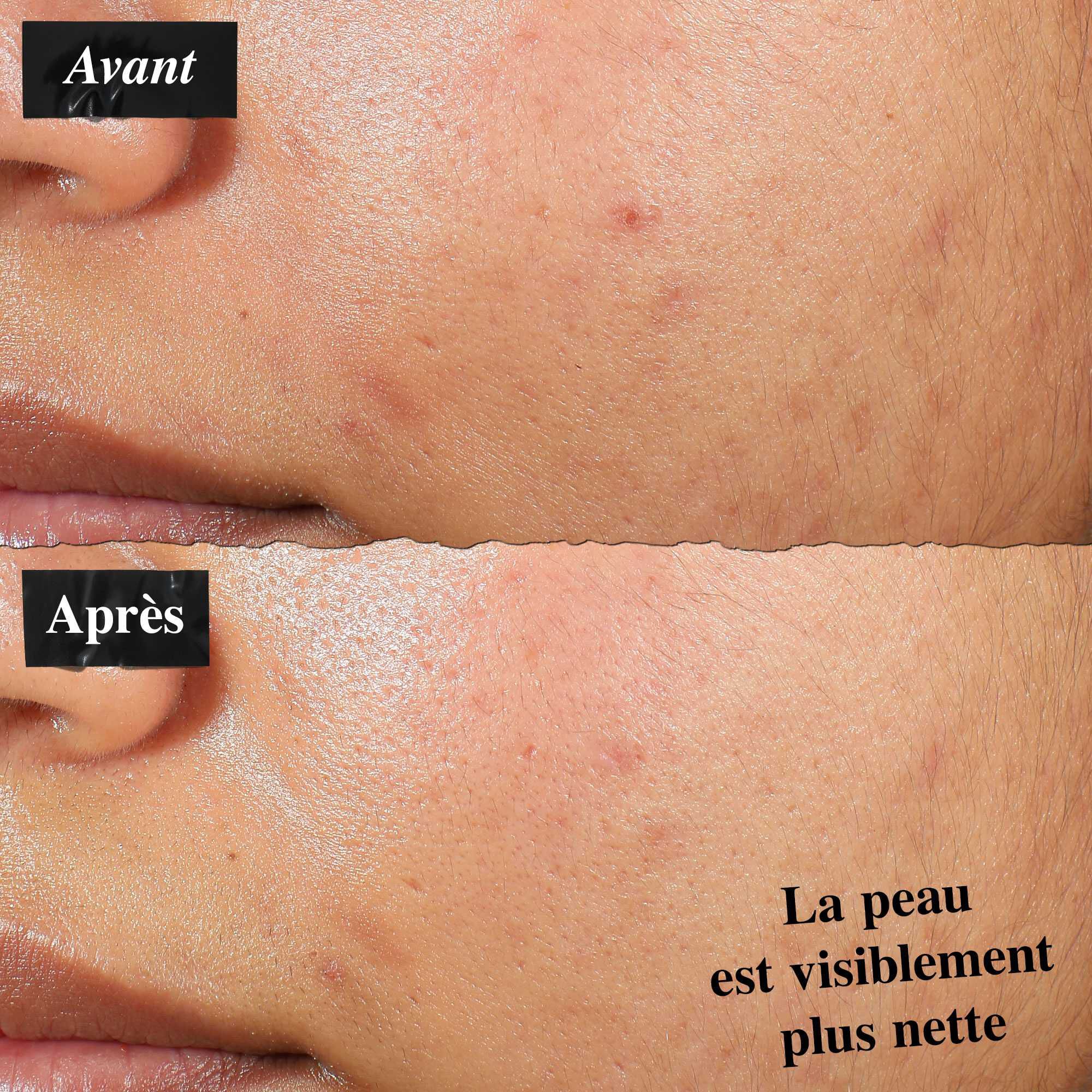 Une comparaison avant/apres montrant une peau traitee avec la lotion Expertly Clear Blemish-Treating & Preventing Lotion. L'image « avant » montre des imperfections et une texture inegale, tandis que l'image « apres » montre une peau visiblement plus nette.
