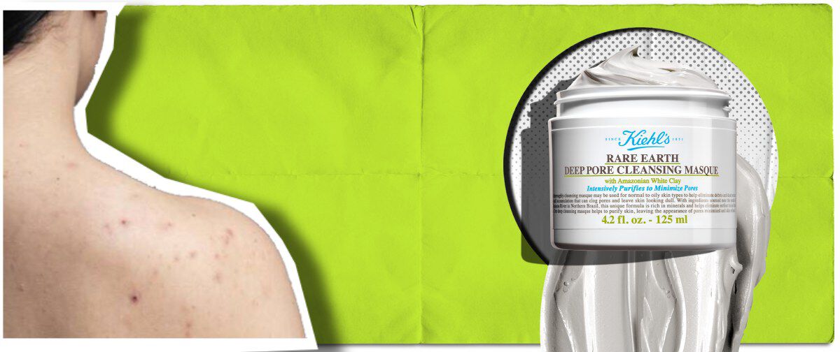 Une personne avec des imperfections sur le dos. Le masque Kiehl's Rare Earth, presente avec sa texture cremeuse, pour aider a purifier la peau et minimiser les pores.