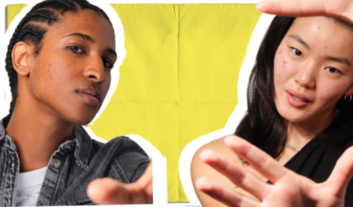 Comment corriger l'acne du visage sur le menton, le front et les joues