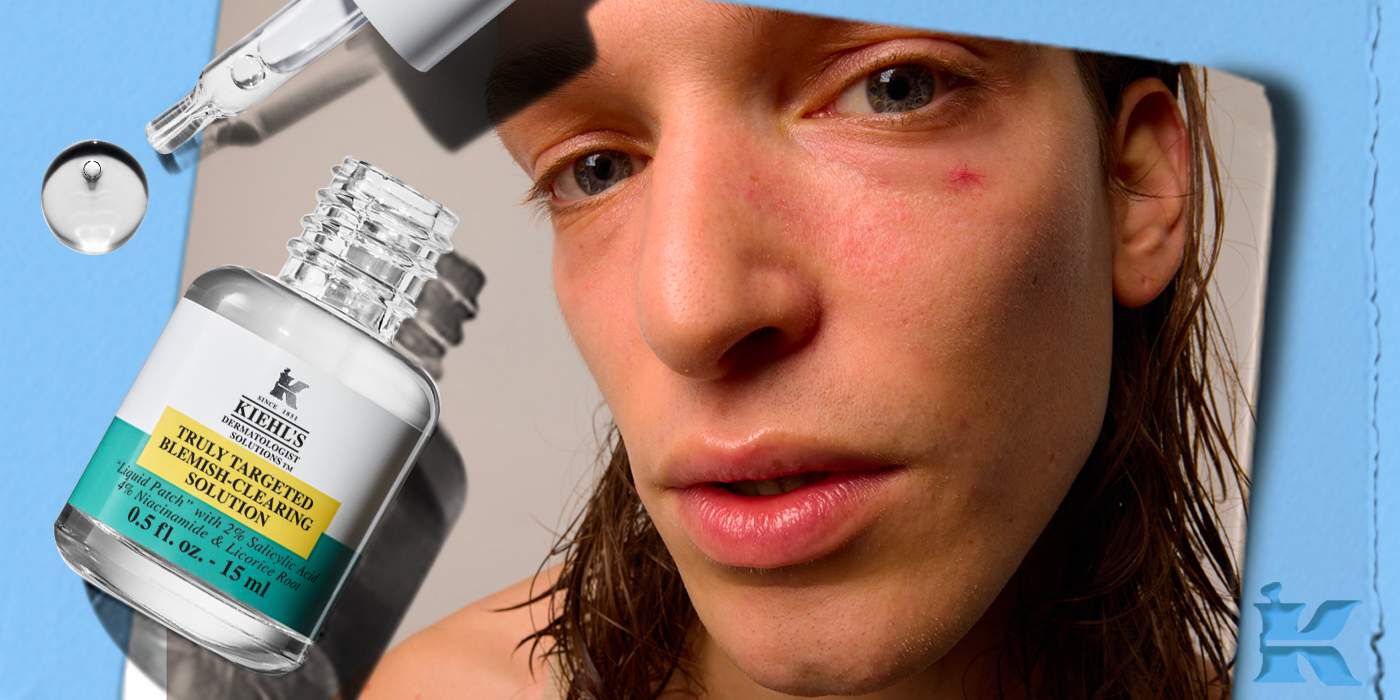 Femme avec des marques d'acne et 2 produits Kiehl's pour les traiter:  Truly Targeted Blemish-Clearing Solution et Expertly Clear Blemish-Treating & Preventing Lotion